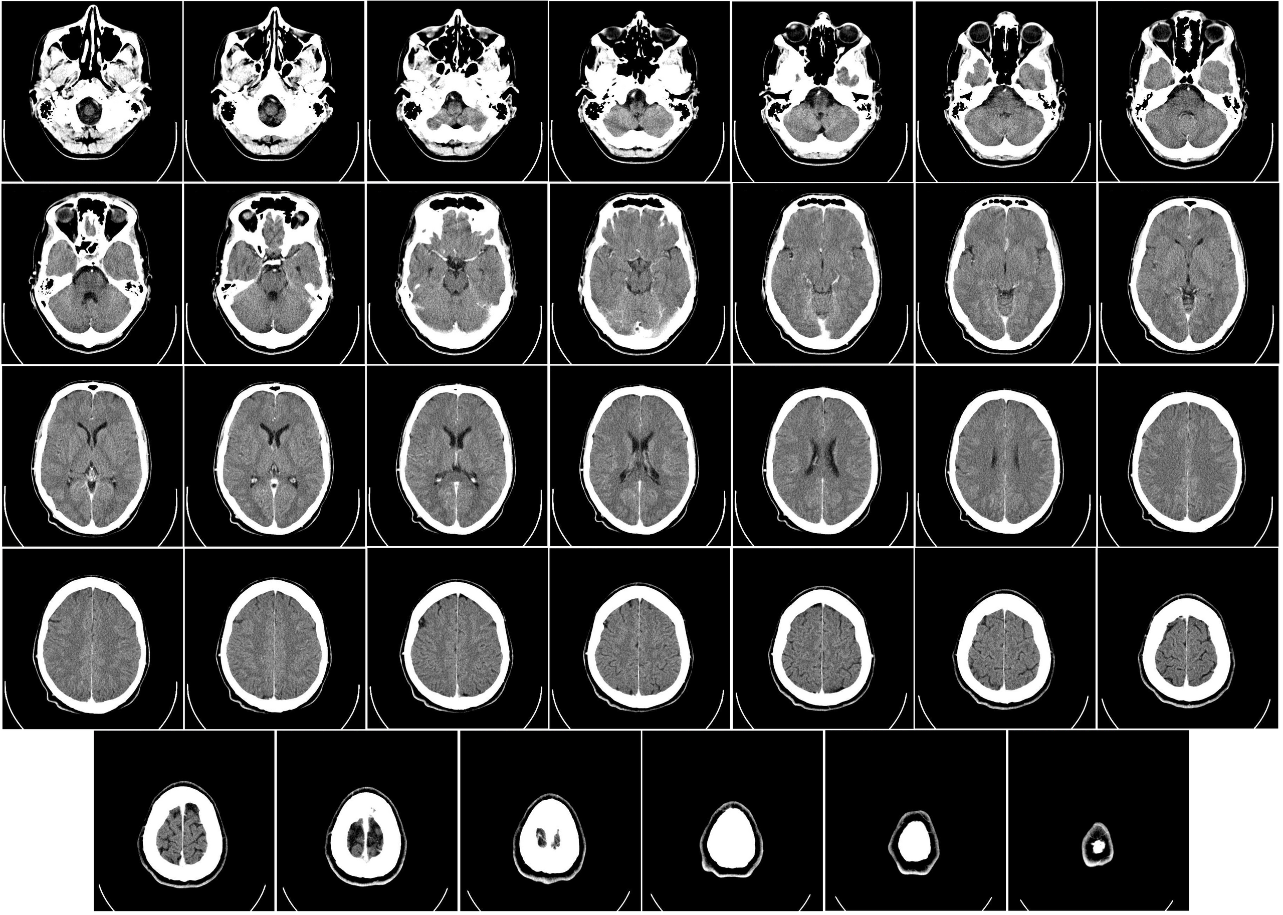 Computed_tomography_of_human_brain_-_large-2